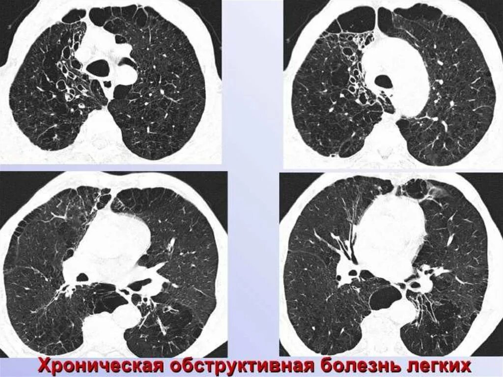 Хобл на кт легких. Компьютерная томография (кт) легких. Кт больных легких. Бронхоэктазы в легких на кт. Бронхоэктатическая болезнь кт.