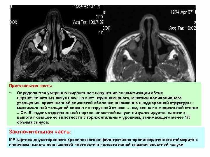 Пневматизация носовых пазух снижена что это такое. Пристеночное снижение пневматизации гайморовых пазух. Понижение пневматизации клиновидной пазухи. Пневматизация верхнечелюстных пазух снижена что это.