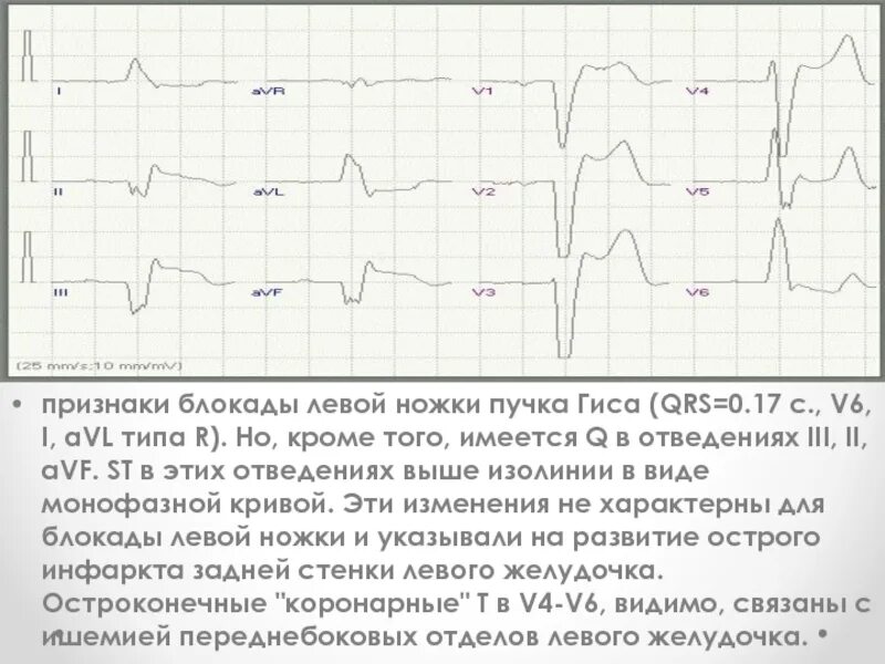 Какие левая ножка пучка гиса. Признаки блокады ножек пучка гиса. для полной блокады левой ножки пучка гиса характерно. признаки блокады левой ножки пучка гиса. причины блокады левой ножки пучка гиса.