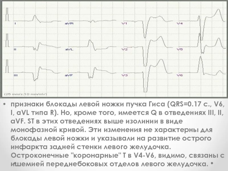 Блокада левой ножки пучка гиса на экг. Признаки блокады ножек пучка Гиса. Для полной блокады левой ножки пучка Гиса характерно. Признаки блокады левой ножки пучка Гиса. Причины блокады левой ножки пучка Гиса.