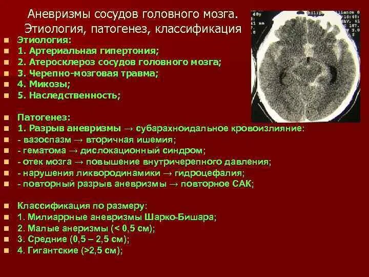 Аневризма головного мозга классификация. Аневризмы сосудов головного мозга классификация. Аневризма сосудов головного мозга патогенез. Этиопатогенез субарахноидального кровоизлияния. Аневризма мозга простыми словами