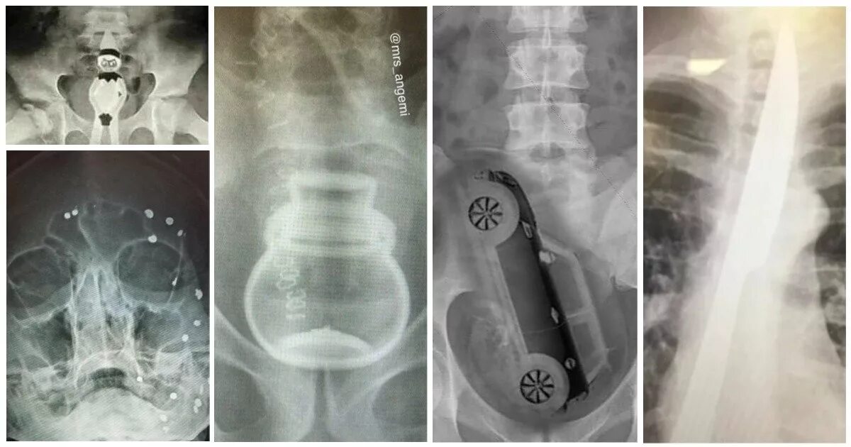 Рентген можно сделать. Инородные предметы на рентгене. Рентгеновские снимки инородных предметов. Инородный предмет в теле.
