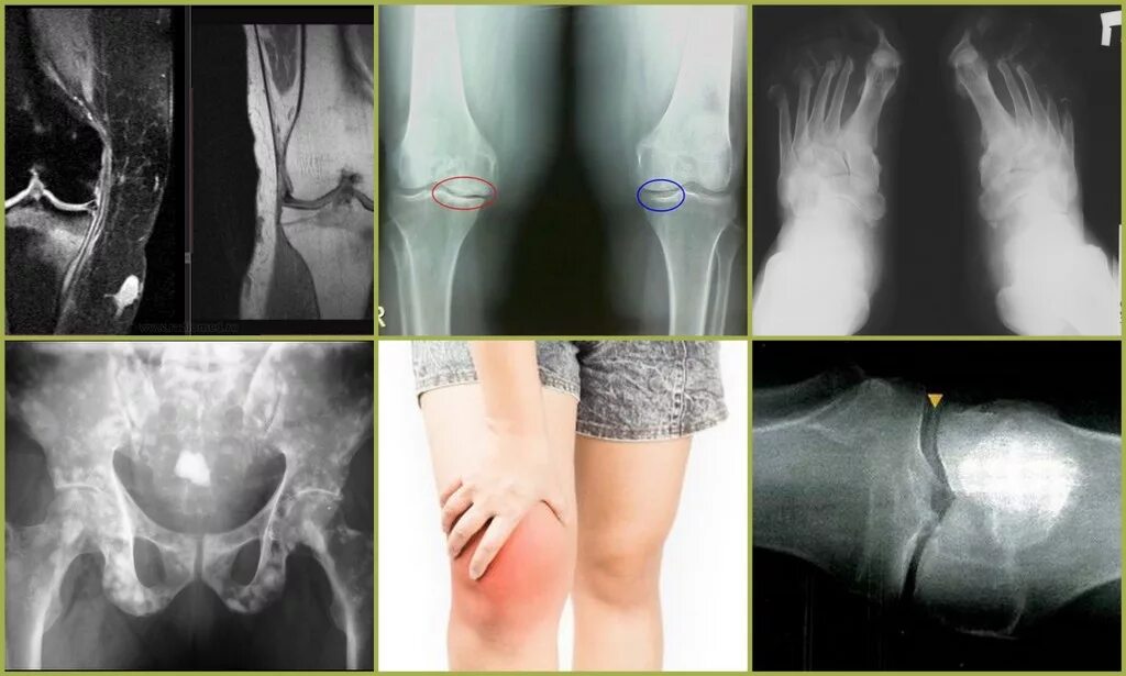 Вторичное поражение костей. Остеосклероз коленного сустава рентген. Остеосклероз костной ткани. Посттравматический остеосклероз.