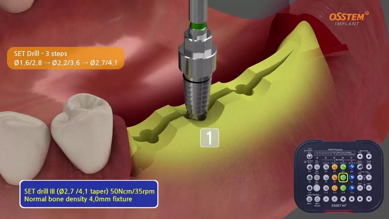 Набор Осстем для имплантации. Осстем набор для имплантации Taper Kit. Набор для расщепления альвеолярного гребня Осстем. Esset Kit набор для расщепления гребня. Hard bone