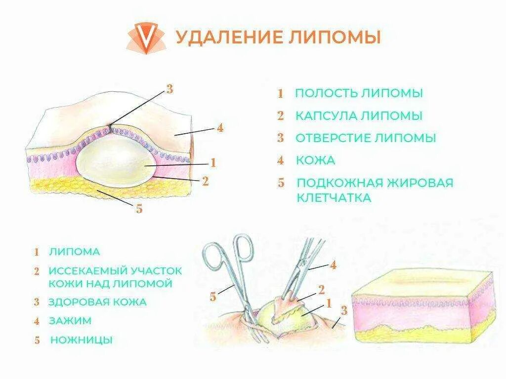 Капсула жировика