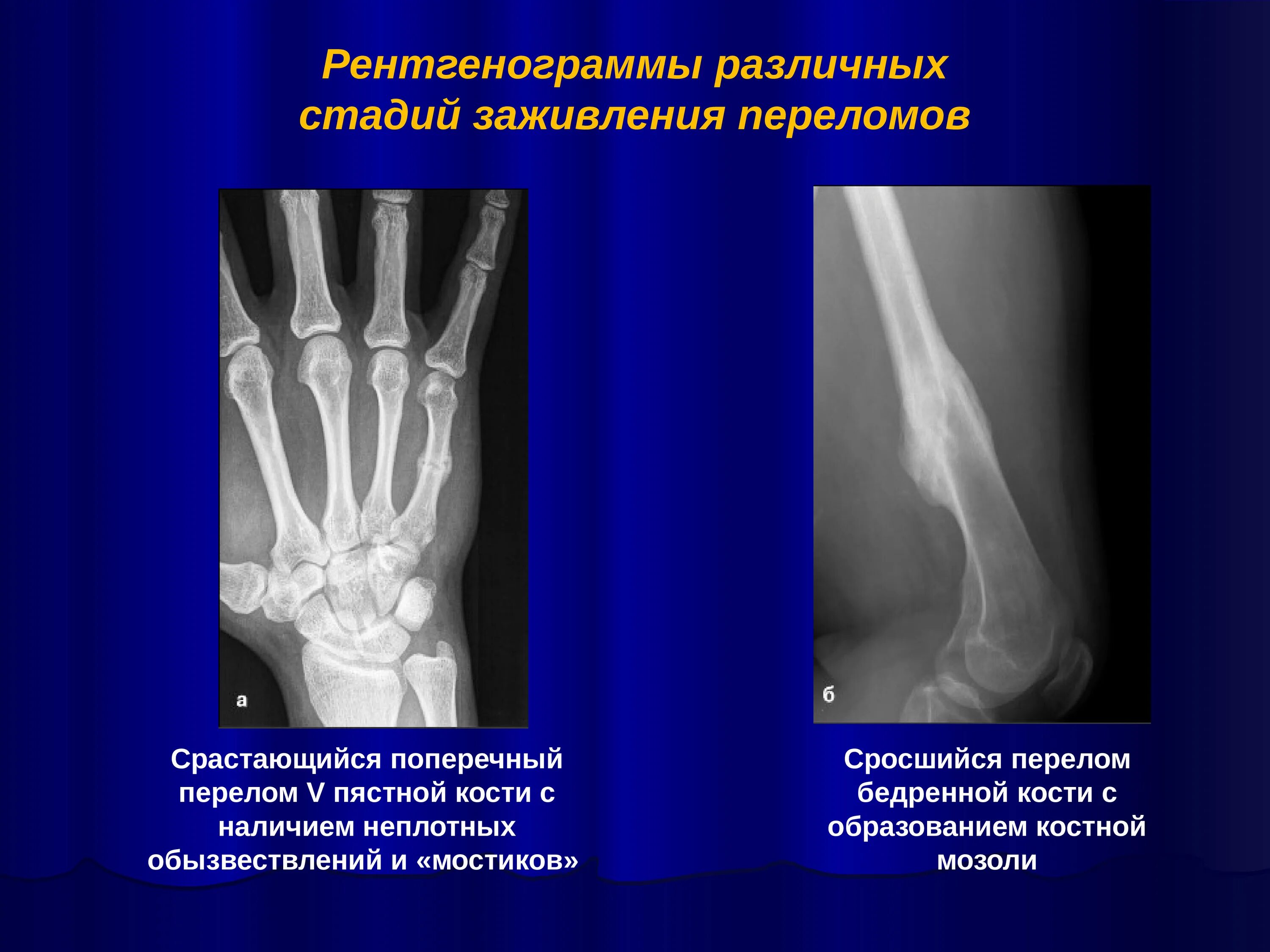 Сколько дней срастается перелом. Субкапитальный перелом 5 пястной кости. Перелом лучевой кости рентгенограмма. Вколоченный перелом пястной кости. Шейка лучевой кости перелом.