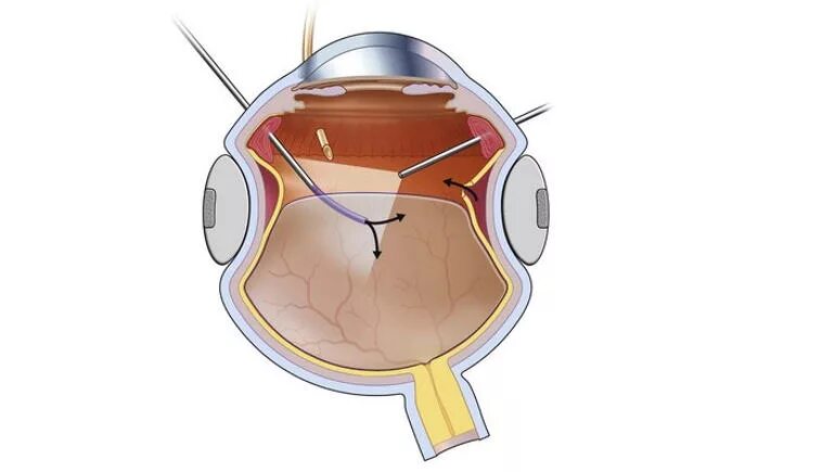 Пломба глаза. Витрэктомия при отслойке сетчатки. Пломбирование отслойки сетчатки. Терапевтическая стоматология. Зубы стоматолог.