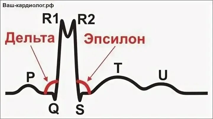 Расщепление зубца. Двойной зубец r на экг. раздвоенный зубец r на экг. раздвоение зубца r на экг. раздвоение зубца r в 3 отведении.