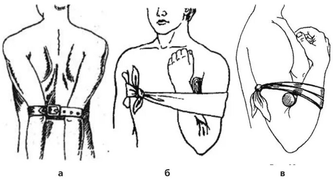 Остановка кровотечения из плечевой артерии. Наложение жгута на подключичную артерию. Наложение жгута при кровотечении из подключичной артерии. Остановка артериального кровотечения на плечевой артерии.