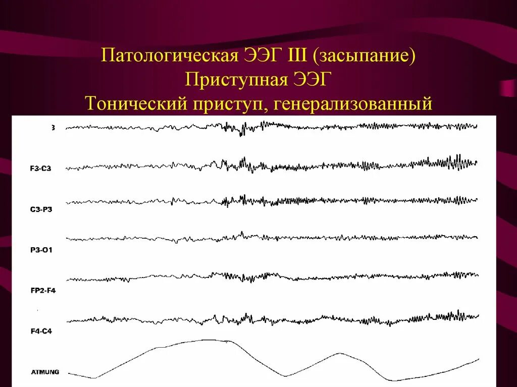 Паттерны ээг. Эпилептиформная активность на ээг. приступ на ээг. эпилепсия на ээг. генерализованный приступ на ээг.