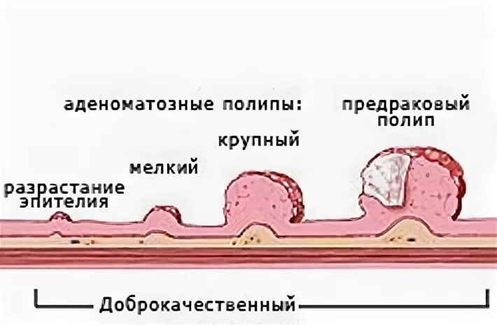 Аденоматозные полипы толстой кишки. Полип (полипоз) эндометрия. Причины образования полипов. Аденоматозные полипы желудка. Дисплазия низкой степени толстой кишки что это