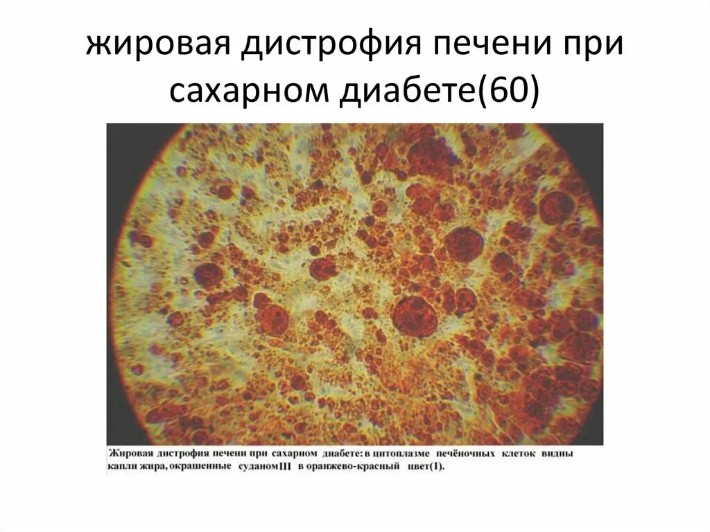 Можно ли печень при сахарном диабете 2. Жировая дистрофия печени при сахарном диабете микропрепарат. Жировая дистрофия печени. Токсическая дистрофия печени патанатомия. Жировая дистрофия печени микропрепарат.