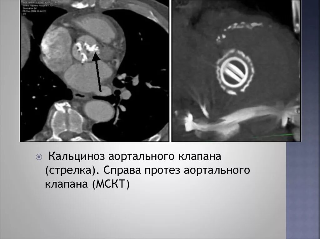 Кальциноз митрального клапана. Кальциноз аортального клапана кт. Стеноз аортального клапана кт. Кальцинат створки аортального клапана. Кальциноз аорты рентген.