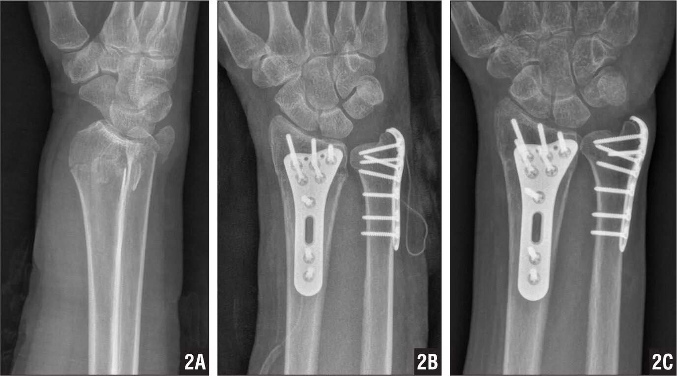 Radius fracture. Radius fracture