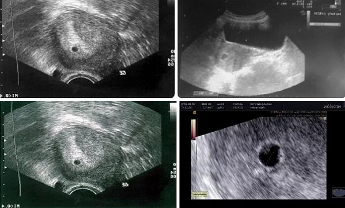 Беременность 3 недели после зачатия. УЗИ 4 недели беременности от зачатия фото плода. Размер зародыша в 4 недели беременности. Эмбрион на 4 неделе беременности от зачатия. УЗИ плода 4 недели беременности от зачатия.