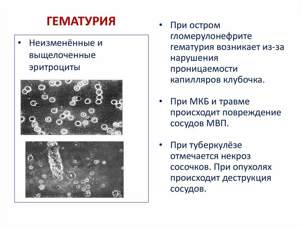 Гематурия при гломерулонефрите. Причины гематурии при гломерулонефрите. патогенез гематурии при гломерулонефрите. эритроцитурия при гломерулонефрите. микрогематурия при гломерулонефрите.