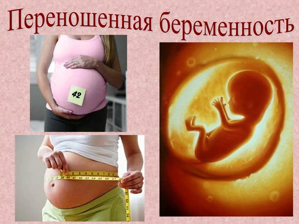 Переношенная беременность. Симптомы переношенной беременности. Переношенная и пролонгированная беременность. Истинно переношенная беременность. Сохранение плода беременности