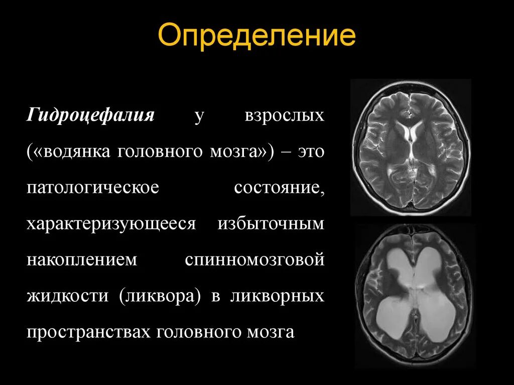 Последствия гидроцефалии головного мозга