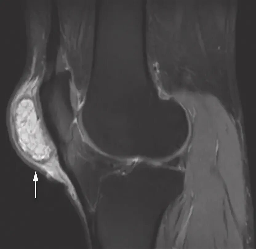 Препателлярный бурсит. Супрапателлярный бурсит мрт. Супрапателлярный бурсит коленного сустава на кт. Препателлярный бурсит мрт.