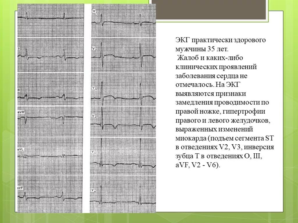 Диффузные изменения экг что это значит. Изменение ЭКГ при миокардиодистрофии. Дистрофические изменения миокарда на ЭКГ. Признаки миокардиодистрофии на ЭКГ. ЭКГ при алкогольной миокардиодистрофии.