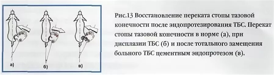 Операция при дисплазии. Эндопротезирование тбс при дисплазии. дисплазия тазобедренных суставов у шпица.
