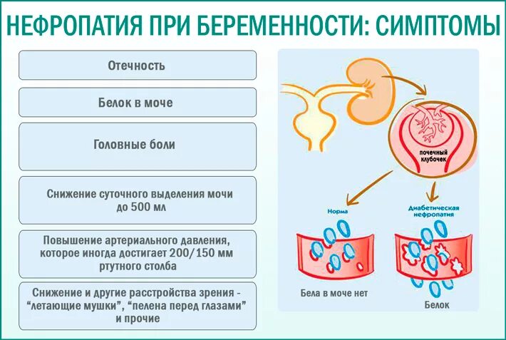 Отеки и белок в моче. Гестоз нефропатия беременных. Нефропатия 2 степени беременных. Нефропатия 1 степени беременных. Нейропатии у беременных.