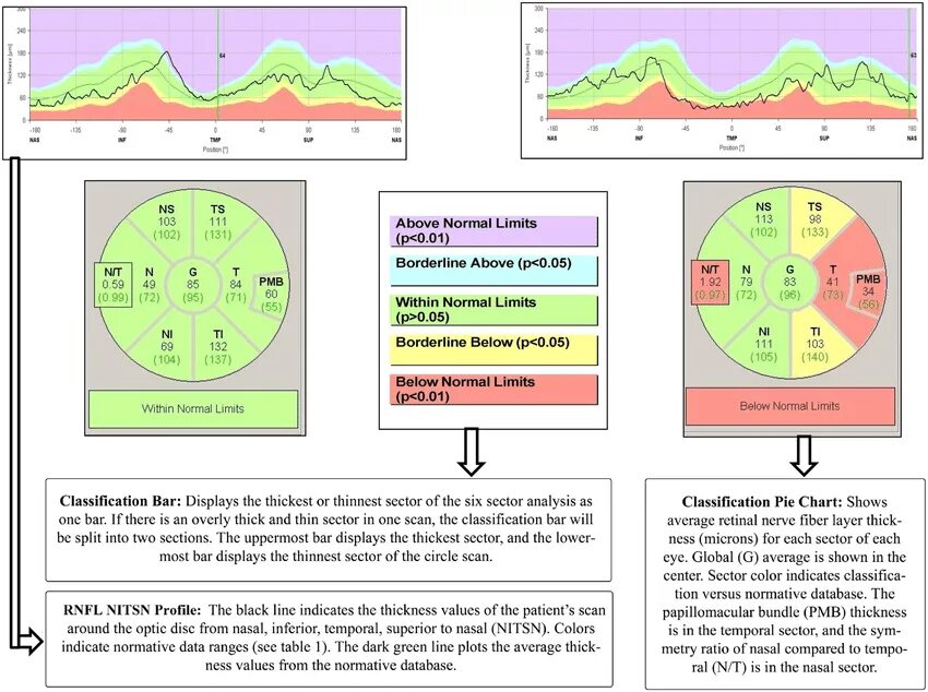 Within normal. Normal rnfl value. normal limits picture. within normal limits picture.