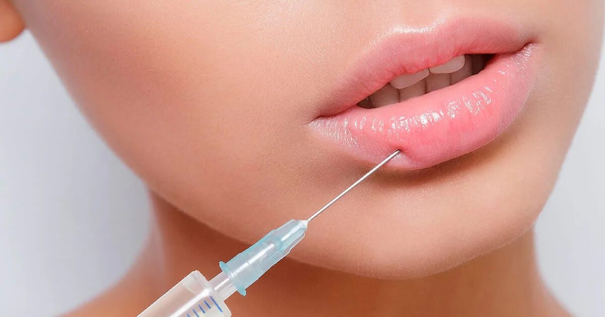 Lip filler