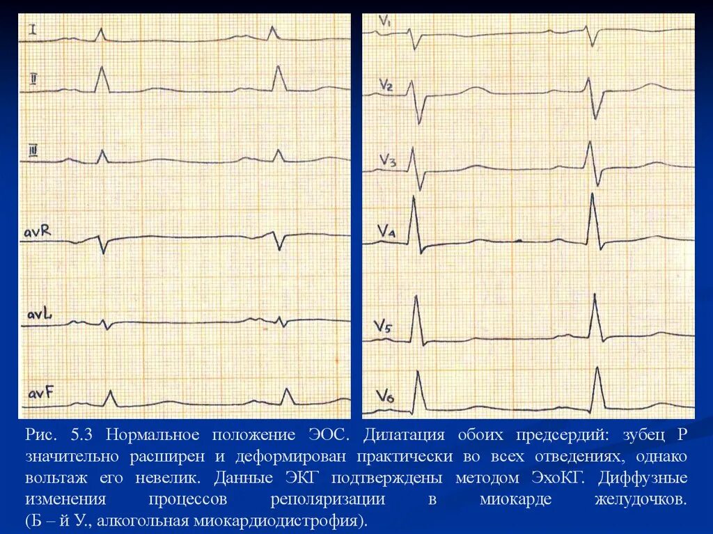 Дилатация правого предсердия ЭКГ. Гипертрофия левого предсердия на ЭКГ. Дилатация предсердий на ЭКГ. ЭКГ при дилатации левого желудочка. Дилатация полостей предсердий