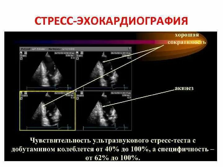 Эхокардиография при стенокардии. Нагрузочная проба стресс эхокг. Стресс эхокг методика. Стресс-эхокардиография методика проведения. Стресс-эхокардиография (стресс-эхокг).