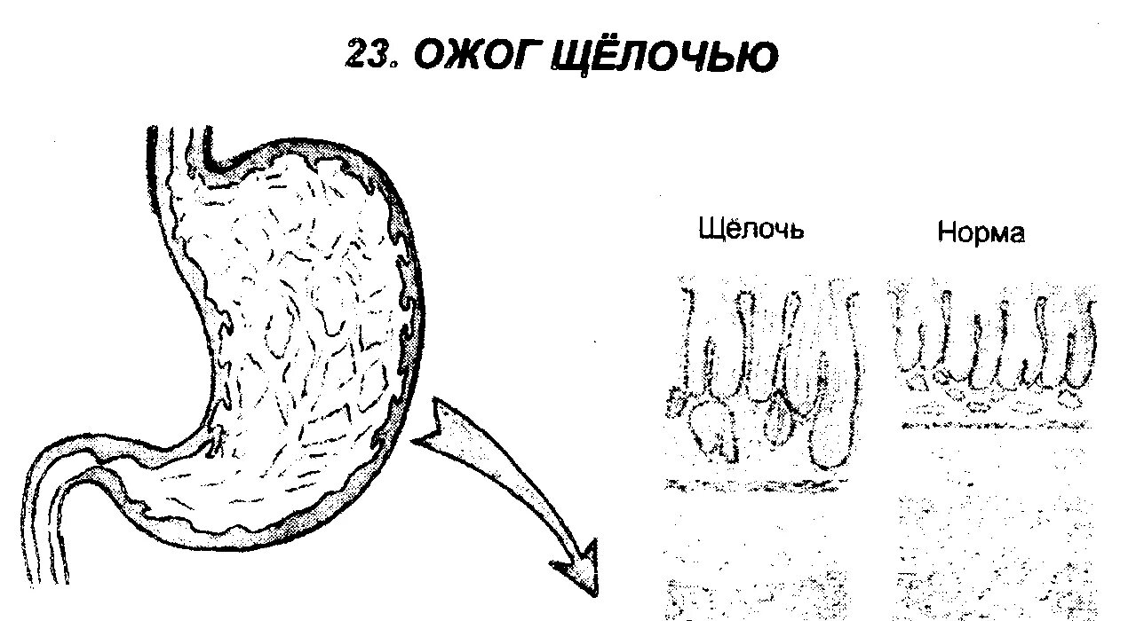 Ожог едкими щелочами. Ожог едкими щелочами