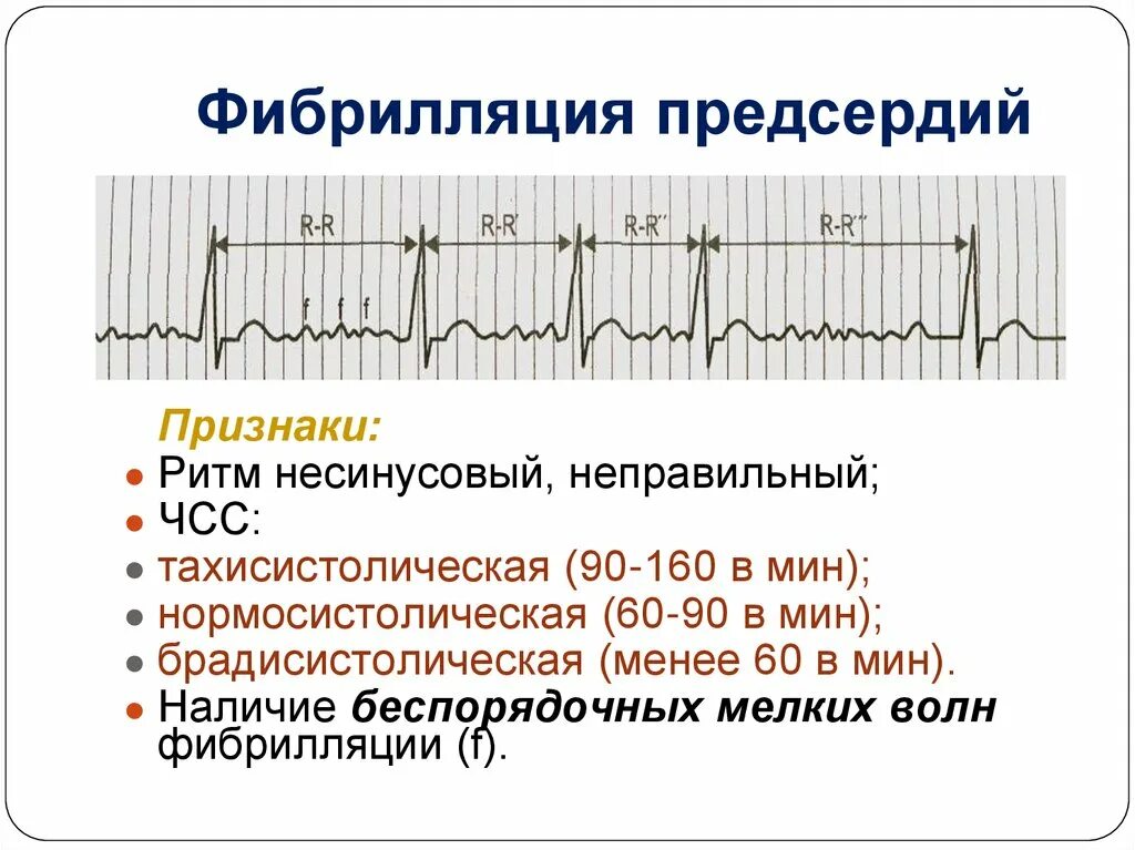 ЧСС при трепетании предсердий. Фибрилляция предсердий ЧСС. Постоянная форма фибрилляции предсердий ЭКГ. Фибрилляция предсердий нормосистолическая форма на ЭКГ. Формы трепетания предсердий