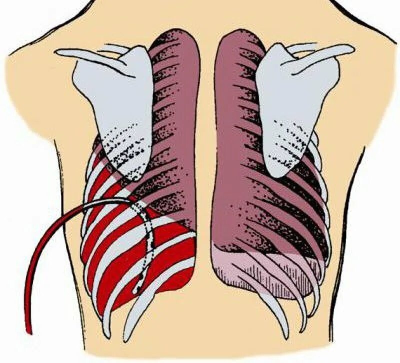 Гемоторакс грудной клетки. Перелом ребер гемоторакс. Гемоторакс кровотечение. Дренирование гемоторакса.