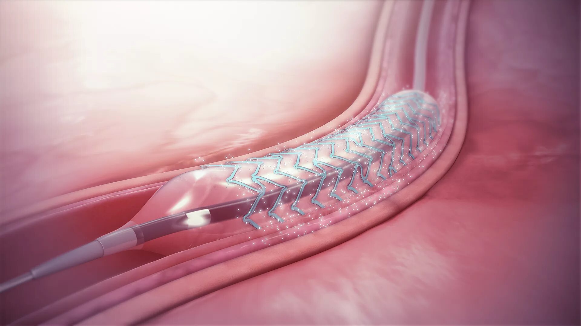 Лекарственный стент. Стент SUPRAFLEX. Стентирование коронарных артерий. Стент Palmaz. Venova стент.