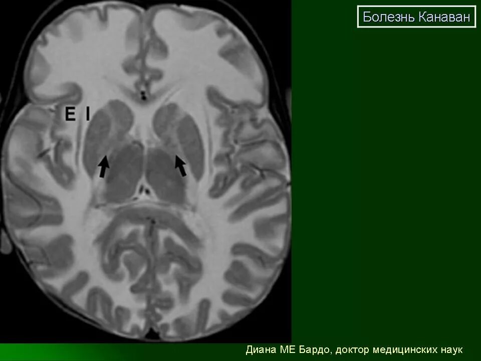 Лейкоэнцефалит. Губчатая дегенерация мозга ван-богарта-бертранда. мрт лейкоэнцефалит ван богарта.
