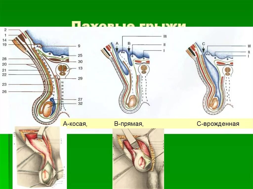 Косая паховая грыжа анатомия. Топографическая прямая паховая грыжа. Прямая, косая, врожденная паховые грыжи. Врожденная косая паховая грыжа схема. Прямая и косая паховые грыжи