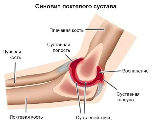 Синовиальные сумки локтевого сустава бурсит. Бурсит локтевого отростка. Супрапателлярный синовит (супрапателлярный бурсит). Подагрический бурсит локтевого сустава.