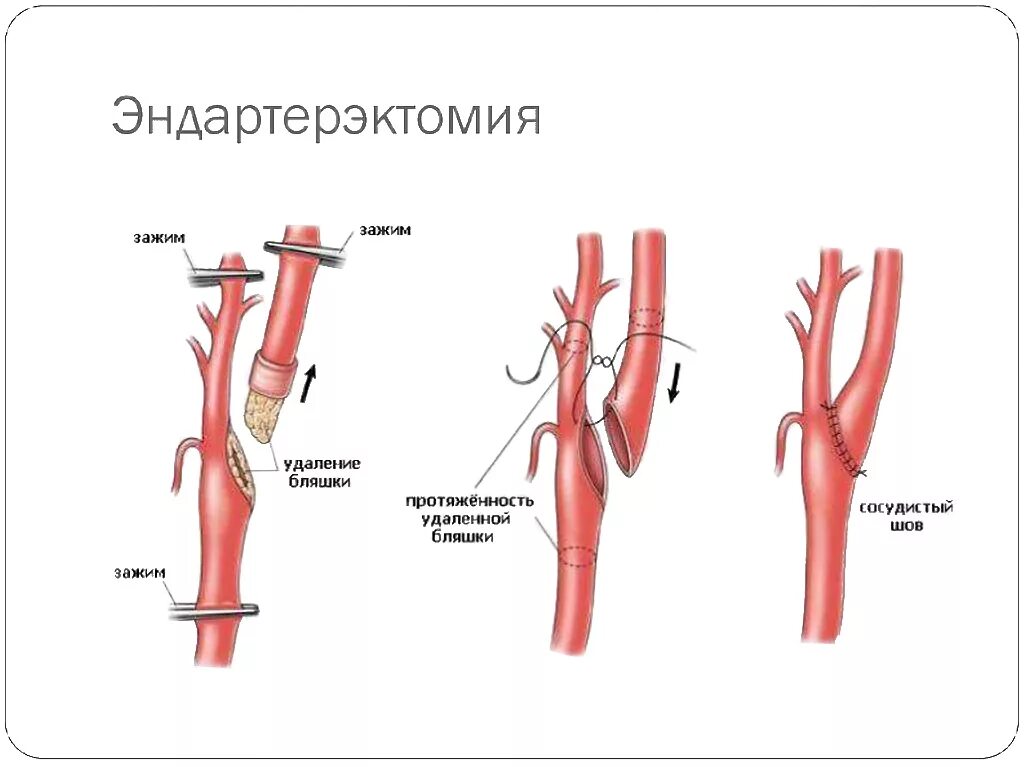 Операция шунтирование нижних. Эверсионная каротидная. Каротидная эндартерэктомия сонной артерии ход операции. Эверсионная эндартерэктомия.