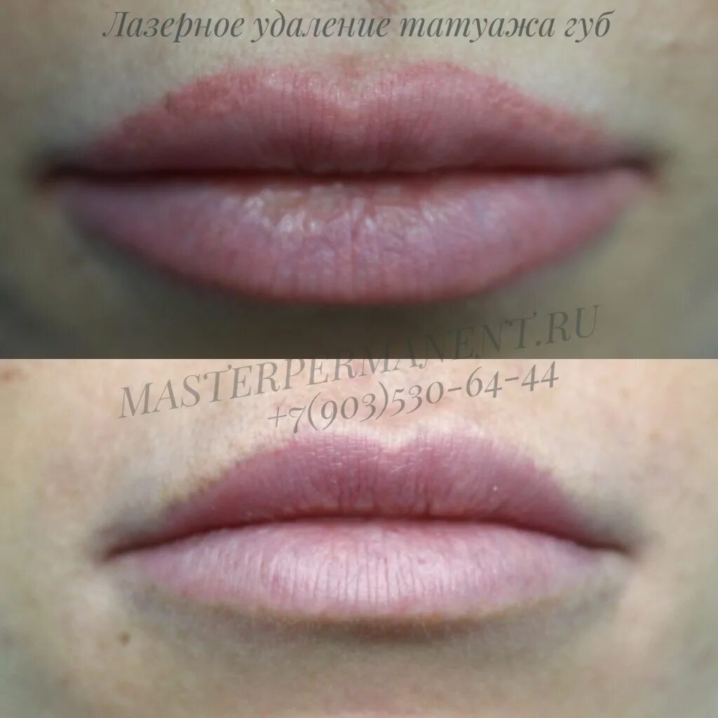Ремувер губ после татуажа. Перманент губ до и после. Губы после резекции. Перманентный макияж губ. Губы после резекции.