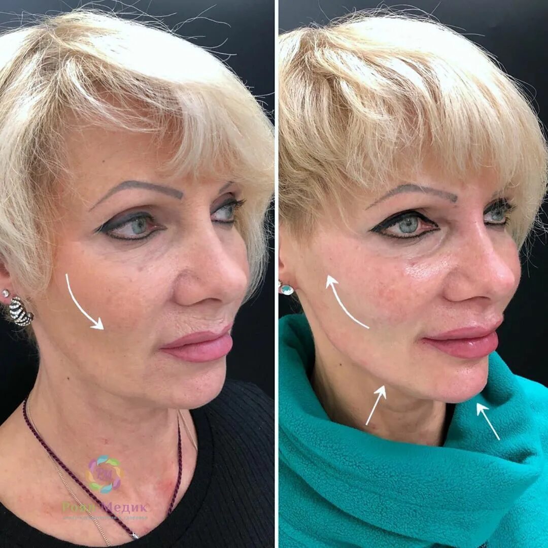 ботокс в щеки. скулы до и после. Radiesse скулы. скулы до и после. отек после филлера в скулы.