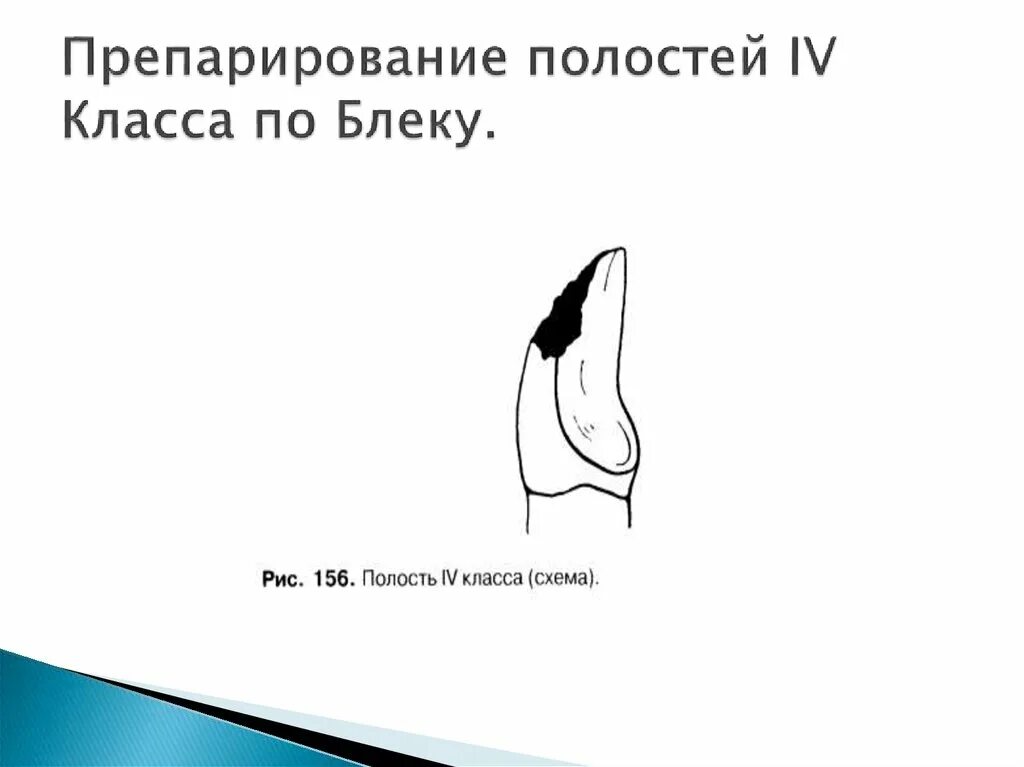 Препарирование полостей 4 класса. Отпрепарированная полость 4 класса по блеку. препарирование 4 класса по блеку.