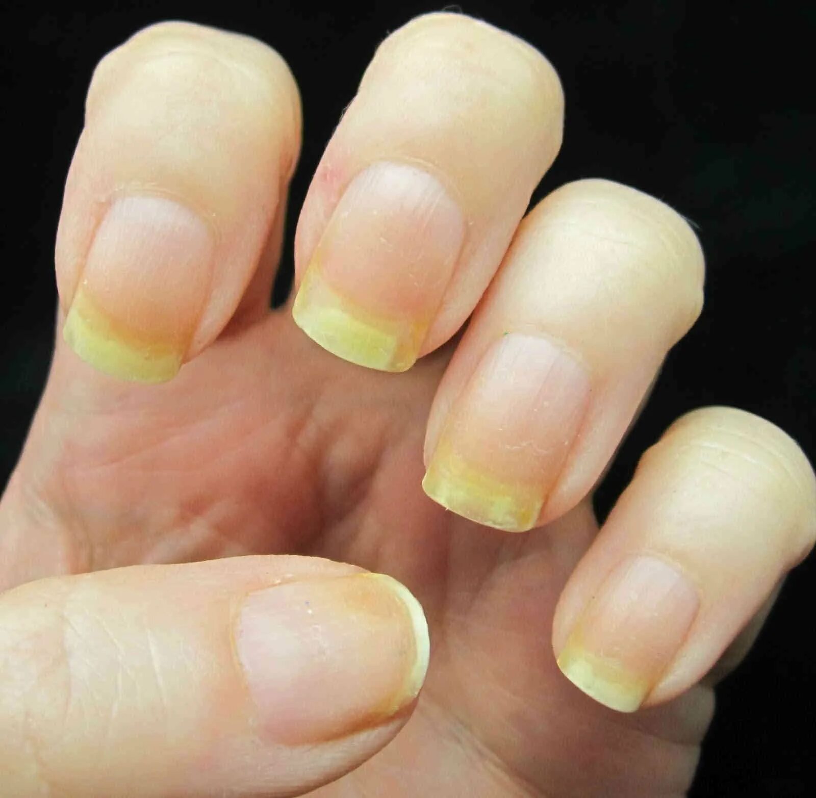 От чего желтеют ногти
