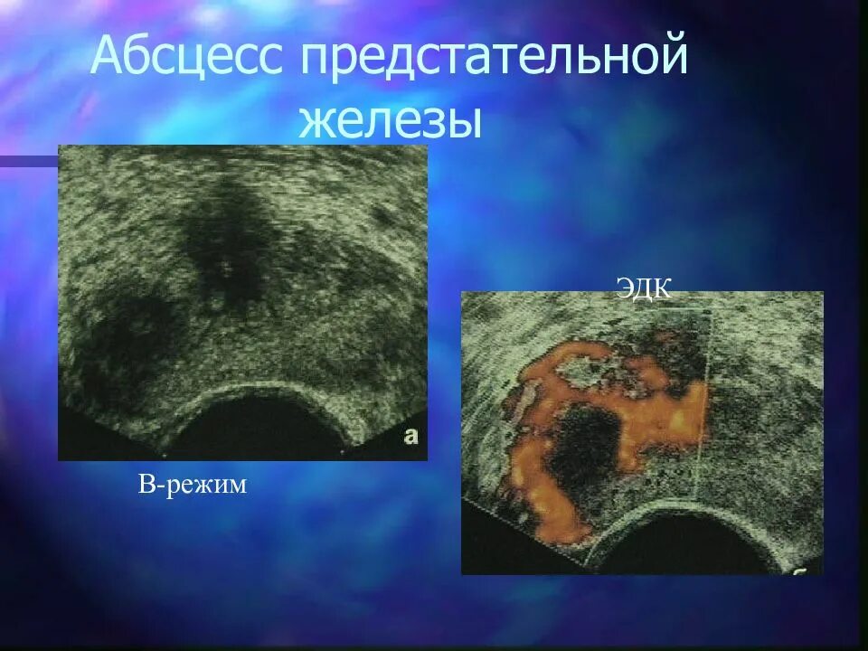 Абсцесс предстательной железы. Дренирование абсцесса предстательной железы. Абсцесс предстательной железы УЗИ. Признаки абсцесса предстательной железы. Нарушение предстательной железы