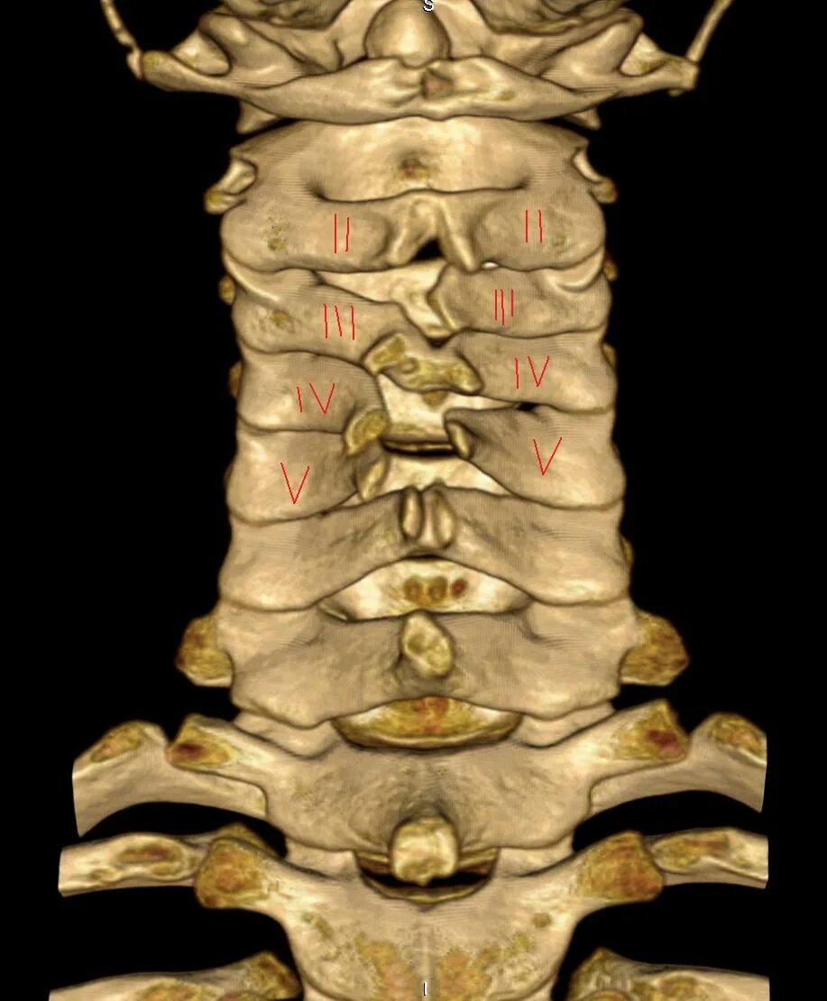 Аномалии с1-с2 позвонков. Бабочковидный позвонок аномалия. Спина бифида шейного позвонка рентген. Th12-l5 позвонков.