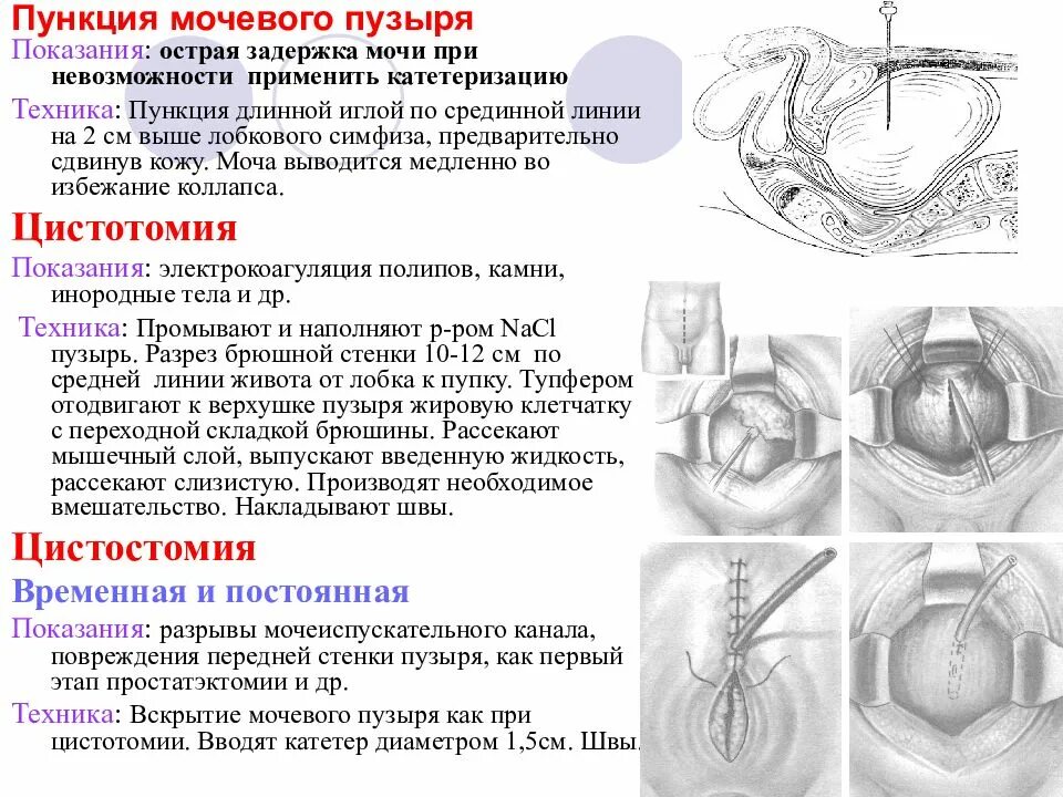 Техника проведения пункции мочевого пузыря. Операции на мочевом пузыре топографическая анатомия. Пункция мочевого пузыря топографическая анатомия. Техника проведения прокола мочевого пузыря:. Пункция через задний свод