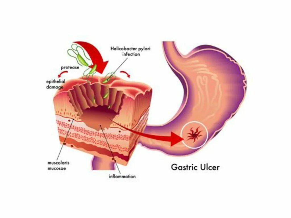Возникновение язвы желудка. Язва желудка и 12 перстной кишки. Язвенная болезнь желудка язвенная болезнь 12 перстной кишки. Язвенная болезнь 12 перстной кишки кишки. Язва желудка и 12 перстной кишки причины.