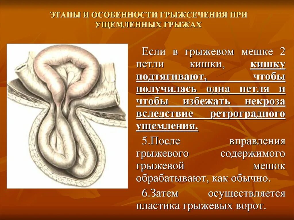 Ущемленная брюшной грыжа. Антеградная ущемленная грыжа. Ущемлённые вентральные грыжи: виды ущемления. Ущемление грыжи ущемление. Ущемленные наружные грыжи.