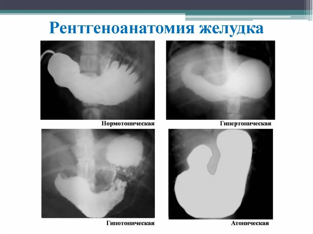 Цистография мочевого пузыря рентген. Рентгеноанатомия желудка. Рентгенологические формы желудка. Тонус рентген. Перфоративная язва желудка рентгенограмма.