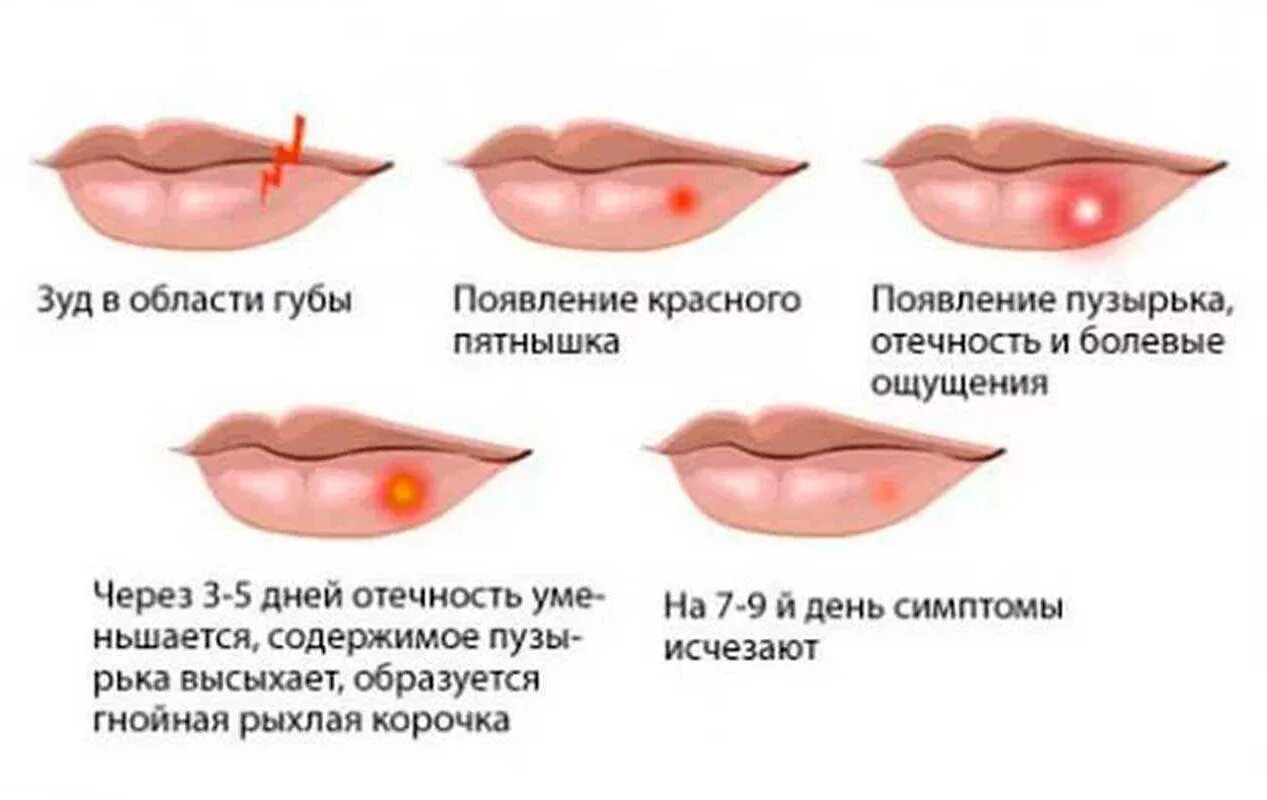 Сколько лечится простуда. Язвочки на губе герпес. Первичный лабиальный герпес. Простудный герпес на губах.