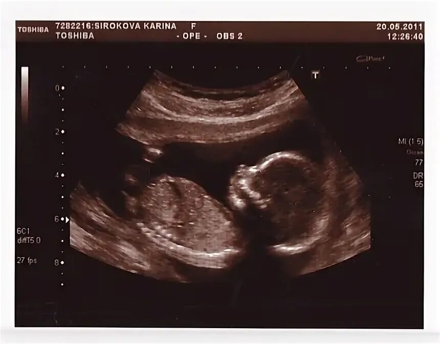 17 недель развитие. УЗИ 17 недель беременности. УЗИ плода 17 недель беременности. 17 Недель беременности фото плода на УЗИ. Снимок УЗИ на 17 неделе беременности.